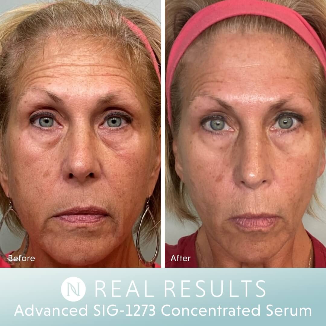 Sig Serum Real Results - Angie